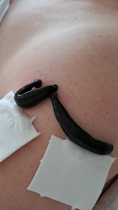 Schwarzer Gegenstand auf Haut, umgeben von weißen Pflastern.